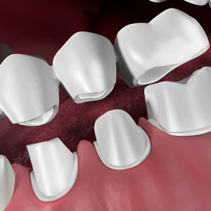 Dental Bridges Dental Bridges